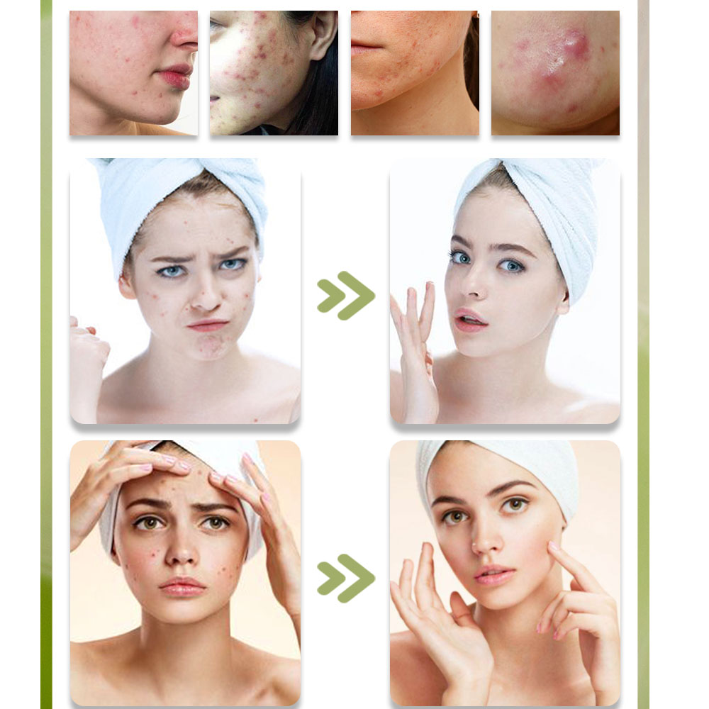 Kstims natural acne tratamento - Tea Tree Spot Treatment avaliação e preço